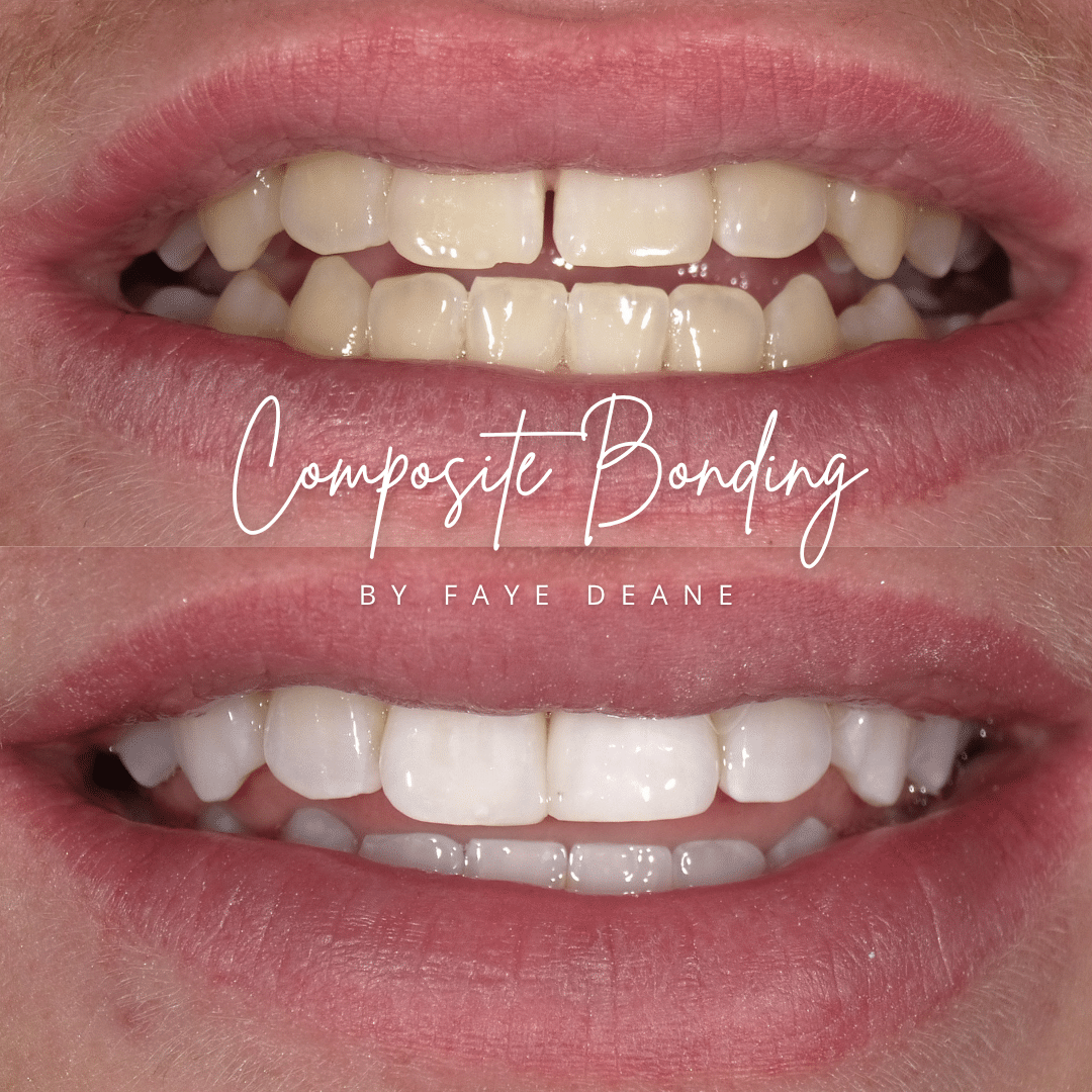 North Bridge Dental Practice Private Dental Practice in Hawick Before And After Composite Bonding Treatment